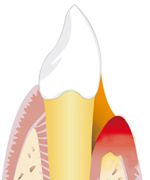 Parodontitisbehandlung